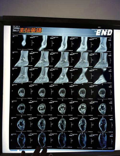 科尔:巴特勒昨天做了脚踝核磁共振检查 结果很正常我们并不担心