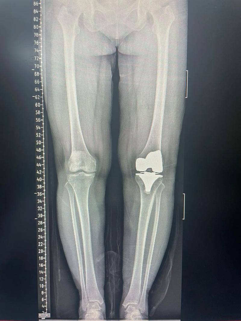 Shams:小萨博尼斯遭遇左膝半月板部分撕裂 3-4周后重新评估!